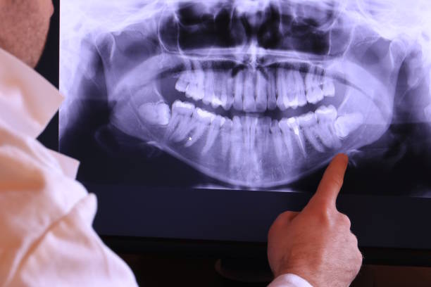 Best Emergency Dental Extractions in Newton, NJ