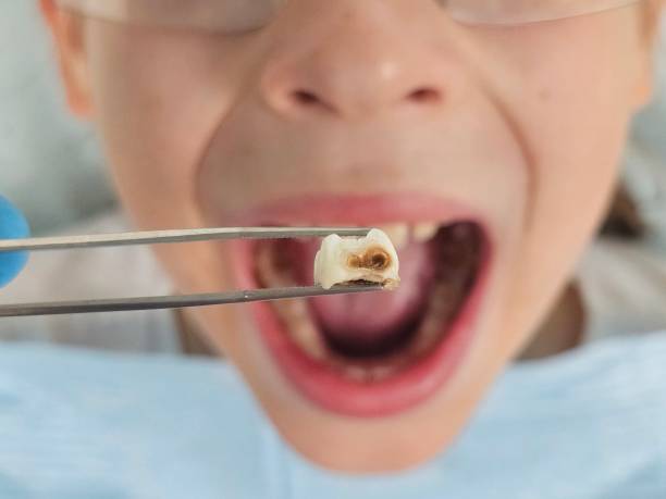 Best Emergency Dental Care for Abscessed Tooth in Newton, NJ